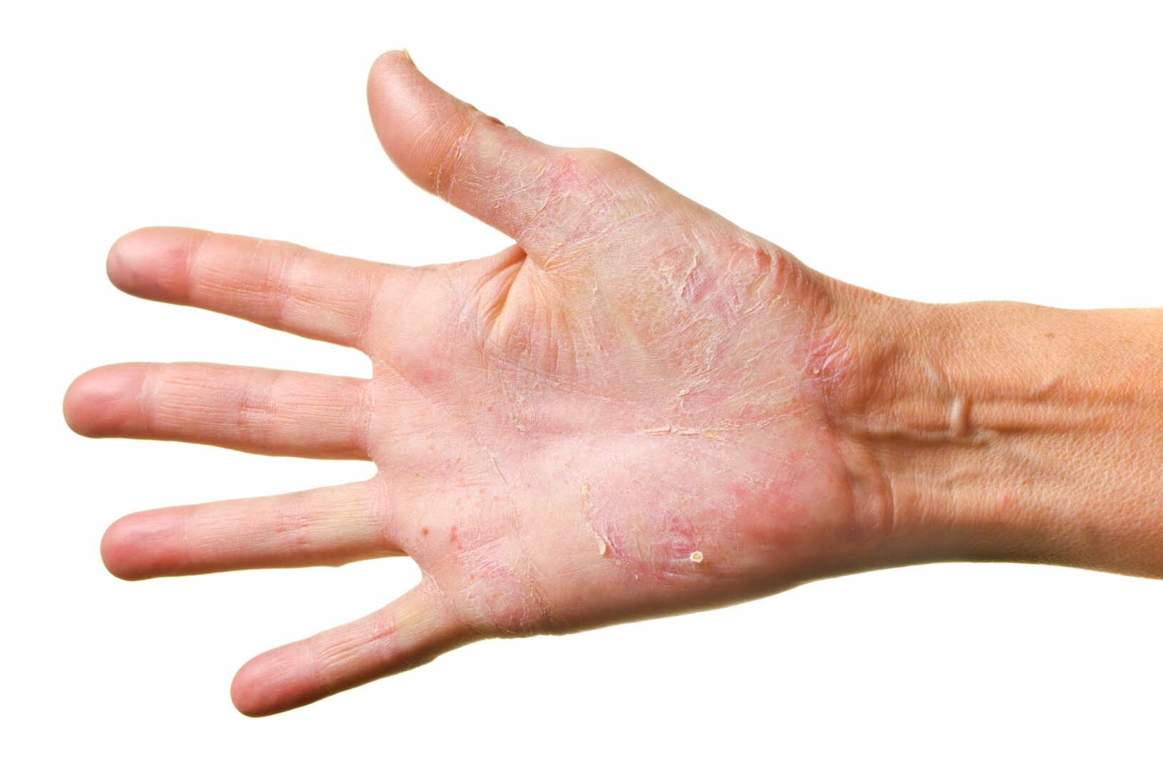 Allergisk reaksjon: Eksem på fingre og hender der huden er i kontakt med strenger eller bånd som inneholder nikkel. 